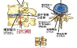 【腰のつらさ】腰部脊柱管狭窄症について